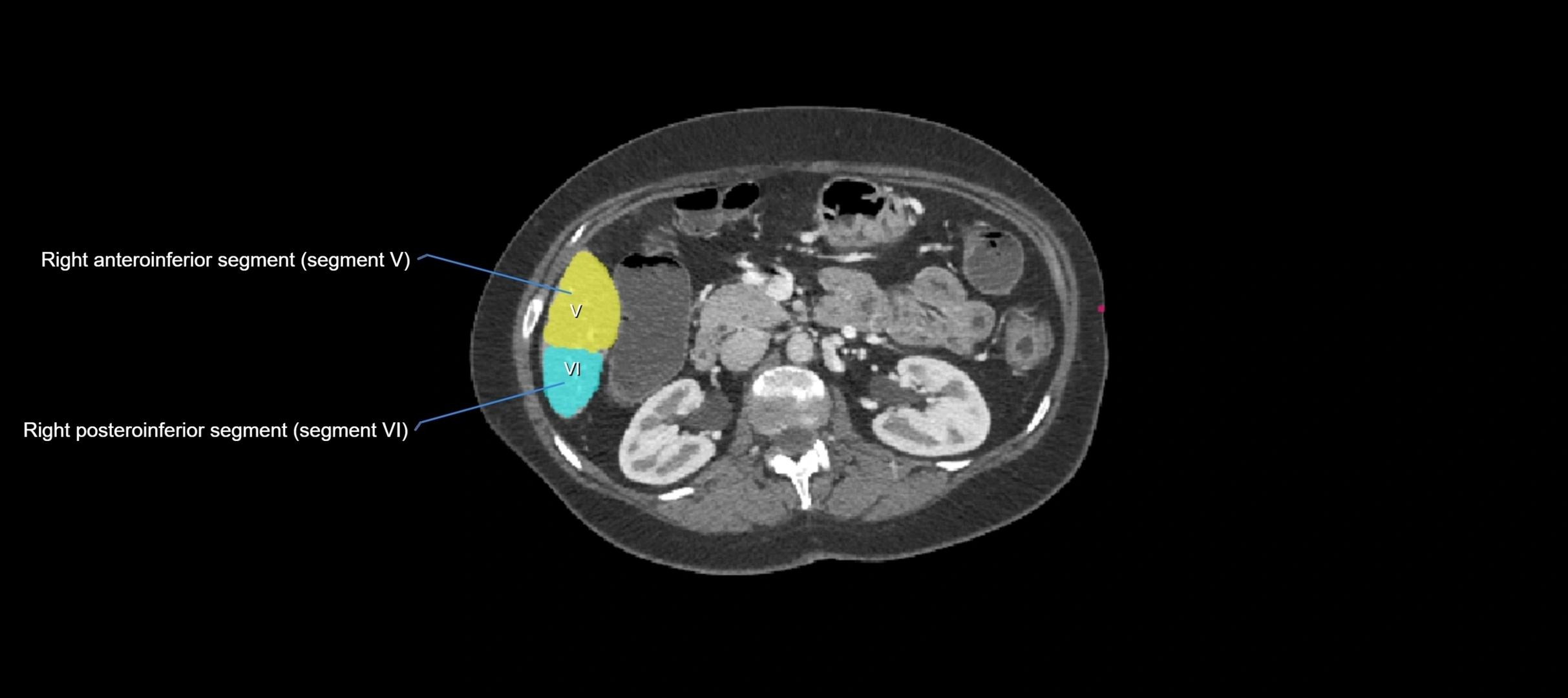 CT liver segments axial cross sectional anatomy labelled image-00021.webp